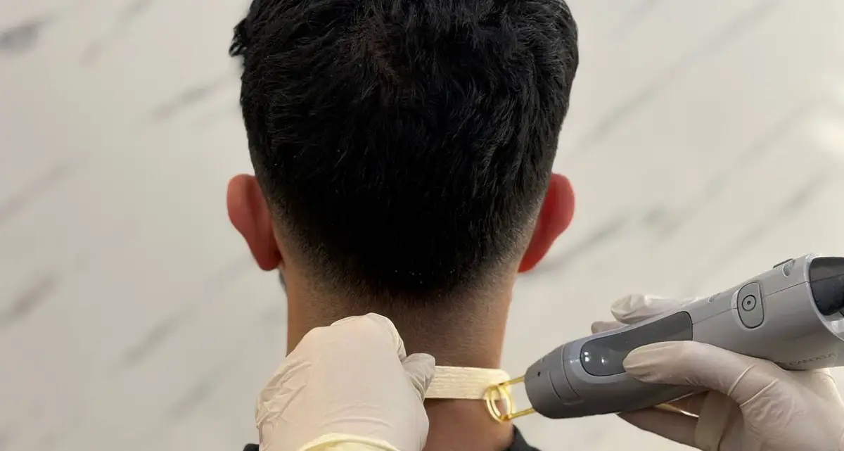 لیزر موهای زائد در گردن