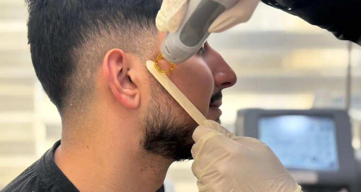 لیزر موهای زاید صورت