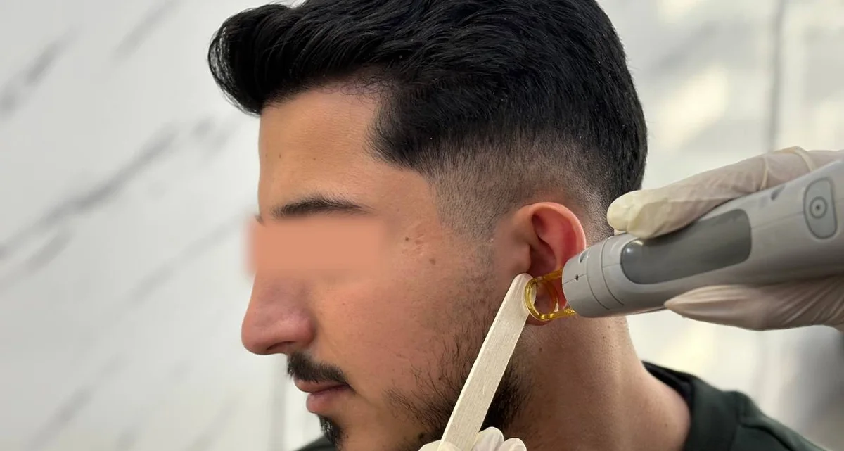 لیزر موهای زاید گوش