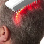 کاشت مو با لیزر؛ 0 تا 100 جدیدترین تکنولوژی کاشت مو