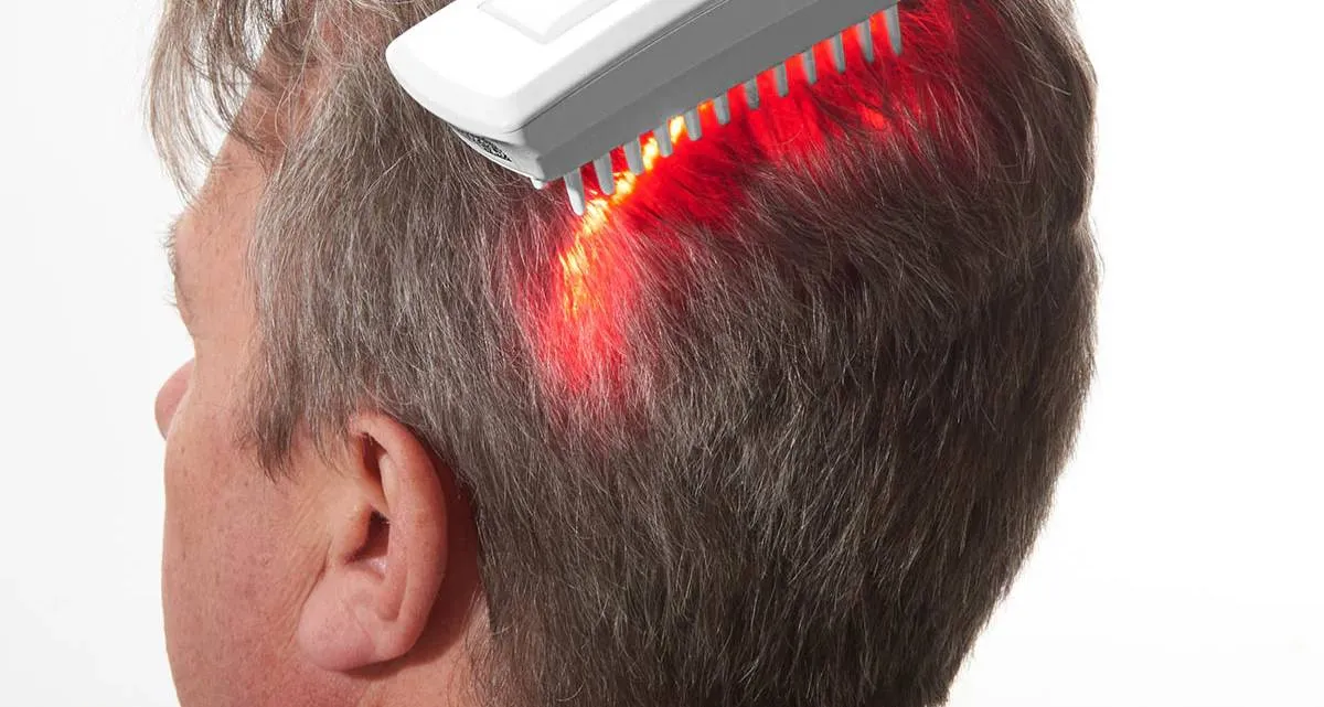 کاشت مو با لیزر؛ 0 تا 100 جدیدترین تکنولوژی کاشت مو