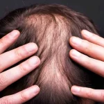 کاشت مو برای بار دوم را کی انجام بدهیم