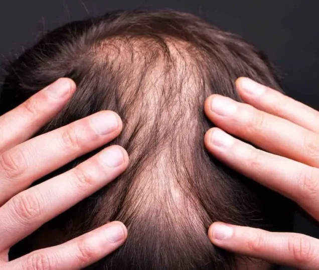 کاشت مو برای بار دوم را کی انجام بدهیم