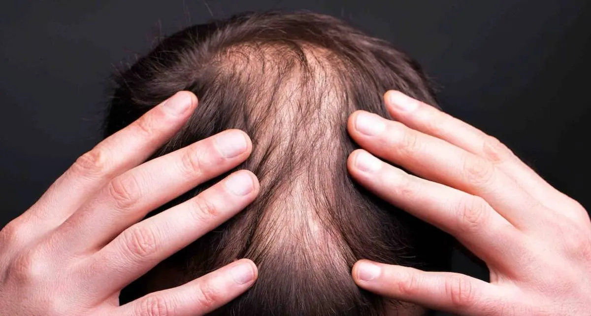 آیا کاشت مو برای بار دوم ممکن است؟