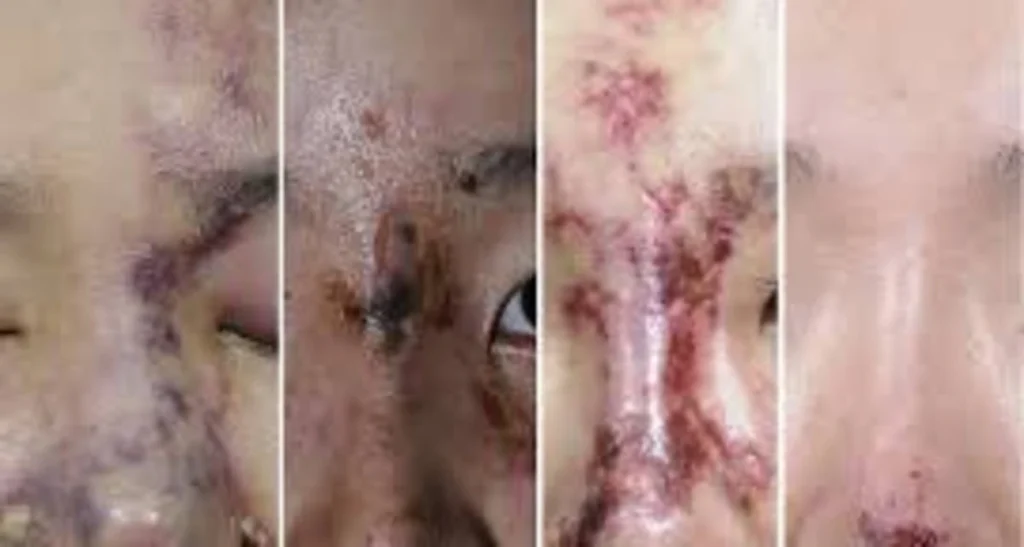 احتمال نکروز با فیلر یا آنزیم