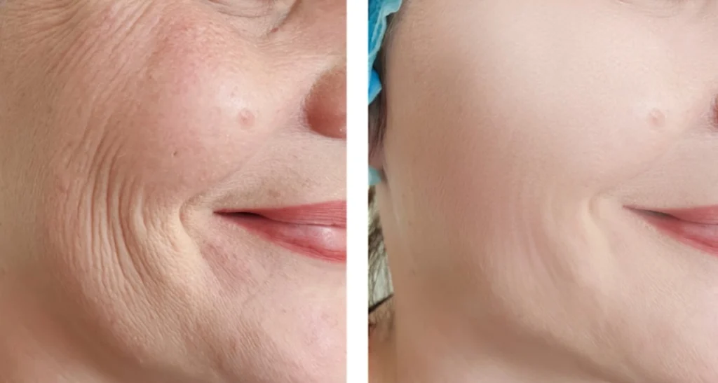 از نظر علمی و پزشکی چند بار میتوان هایفو انجام داد؟