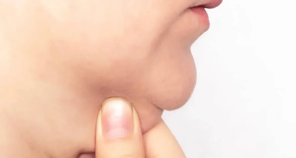 بررسی مکانیسم هایفوتراپی غبغب در کاهش چربی و سفت شدن پوست