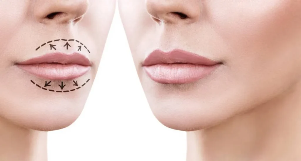 تأثیر سیگار بر ماندگاری و کیفیت فیلر لب در بلندمدت