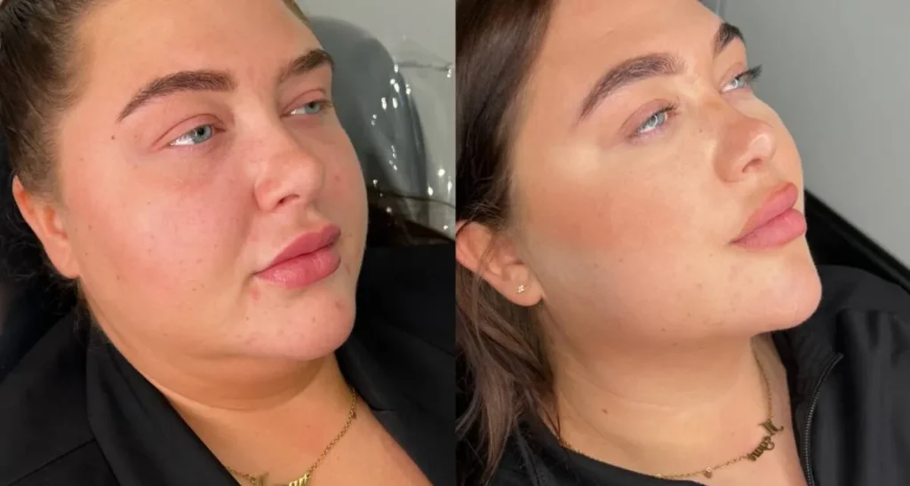 تزریق آنزیم برای رفع چربی چه کاربردی دارد؟