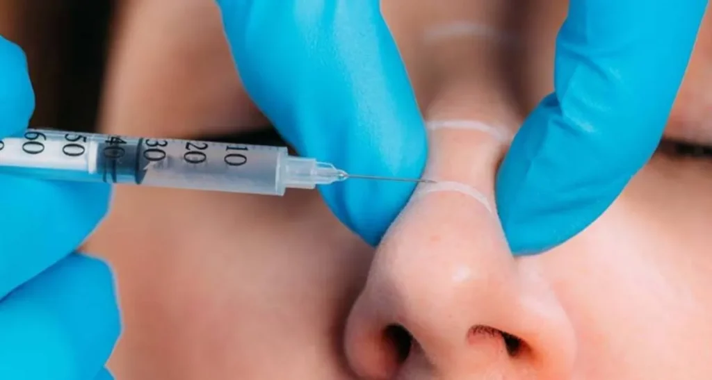 تورم و کبودی بعد از تزریق فیلر بینی