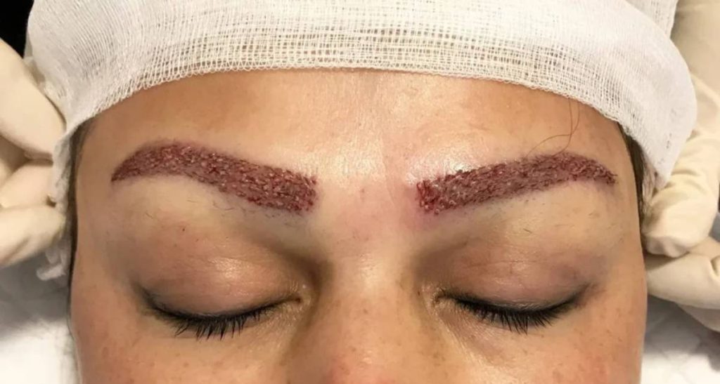 جوش و دلمه بعد از کاشت ابرو