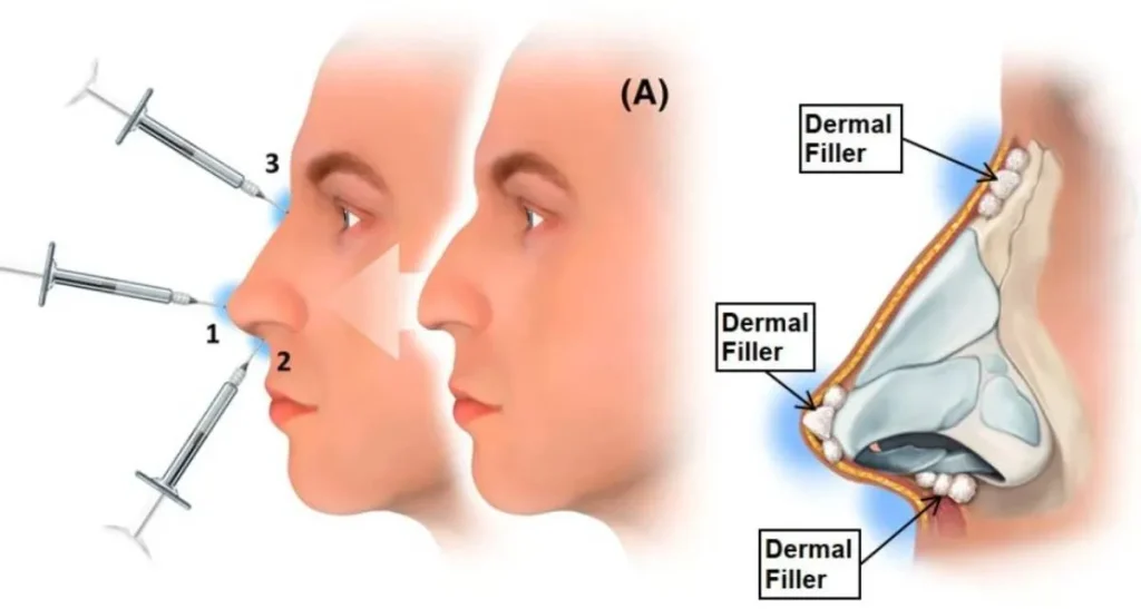 حرکت فیلر بینی