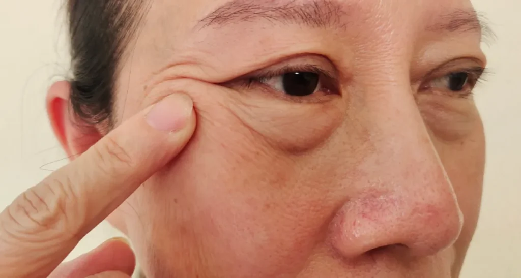 درمان پف زیر چشم