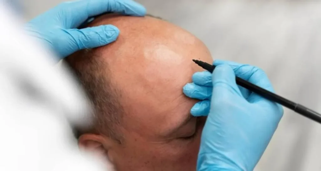 عوارض کاشت مو برای بچه دار شدن