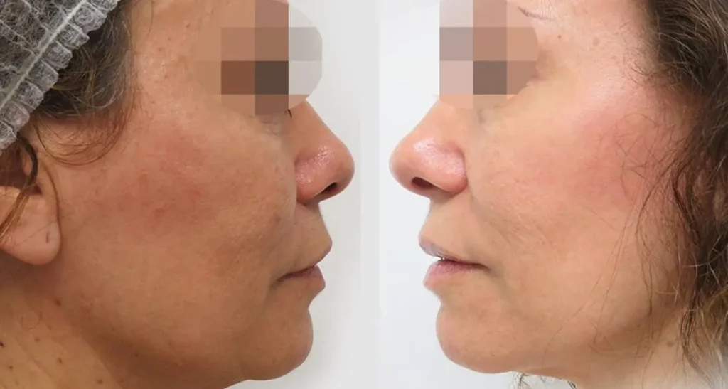 ماندگاری هایفوتراپی صورت چقدر است؟