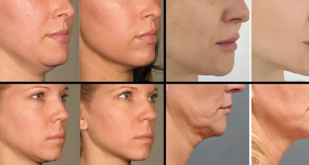 ماندگاری هایفو صورت