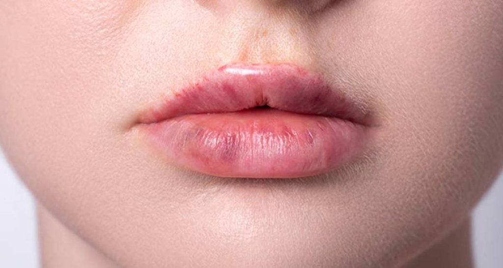 مراقبت های بعد از تزریق آنزیم لب و تخلیه ژل لب