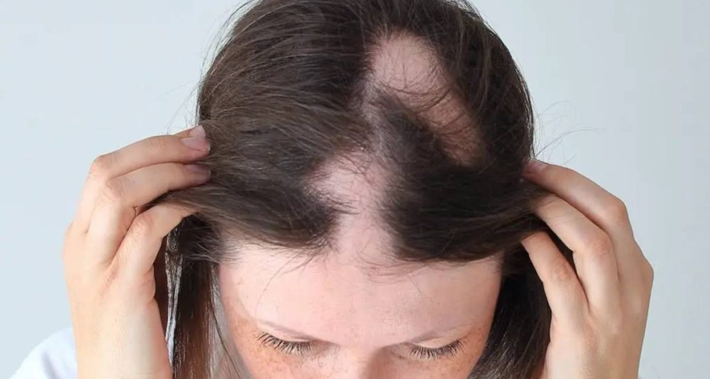 معرفی کامل الگوهای ریزش مو