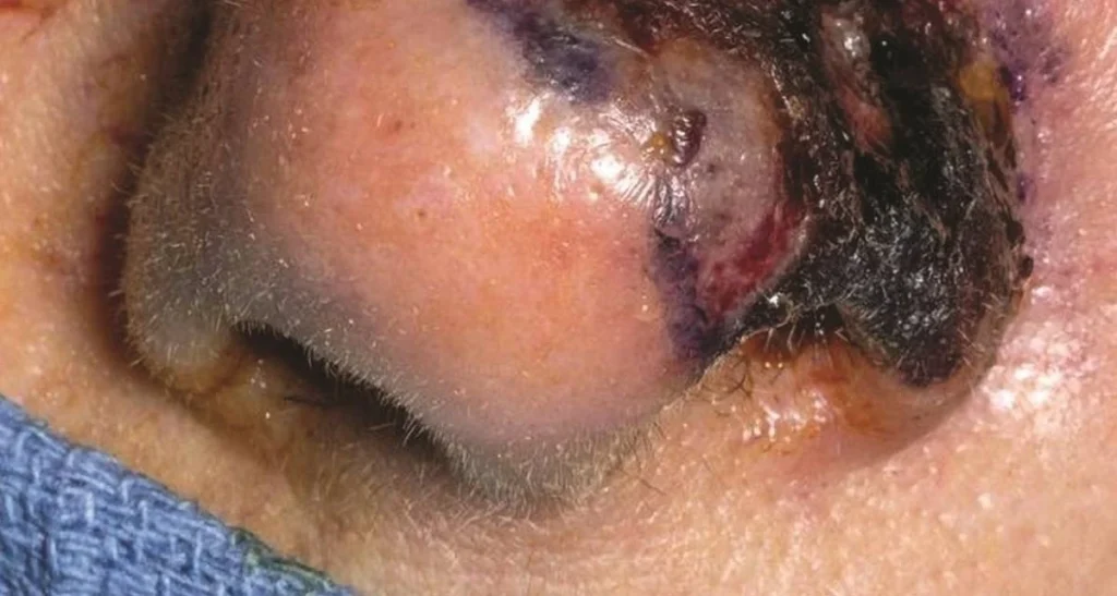 نکروز بینی چیست