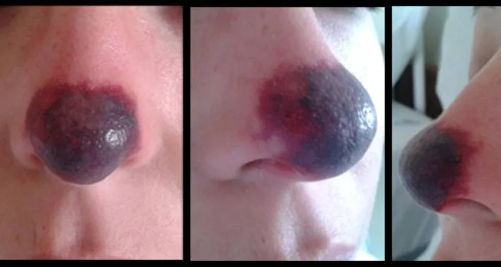 واقعیت های تزریق آنزیم بینی