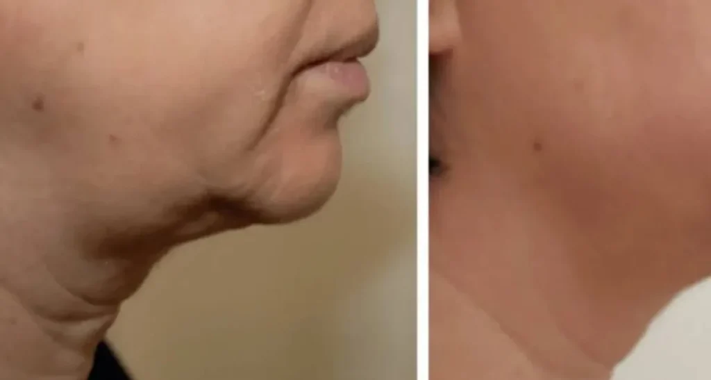 چه افرادی کاندید مناسب هایفوتراپی غبغب هستند؟