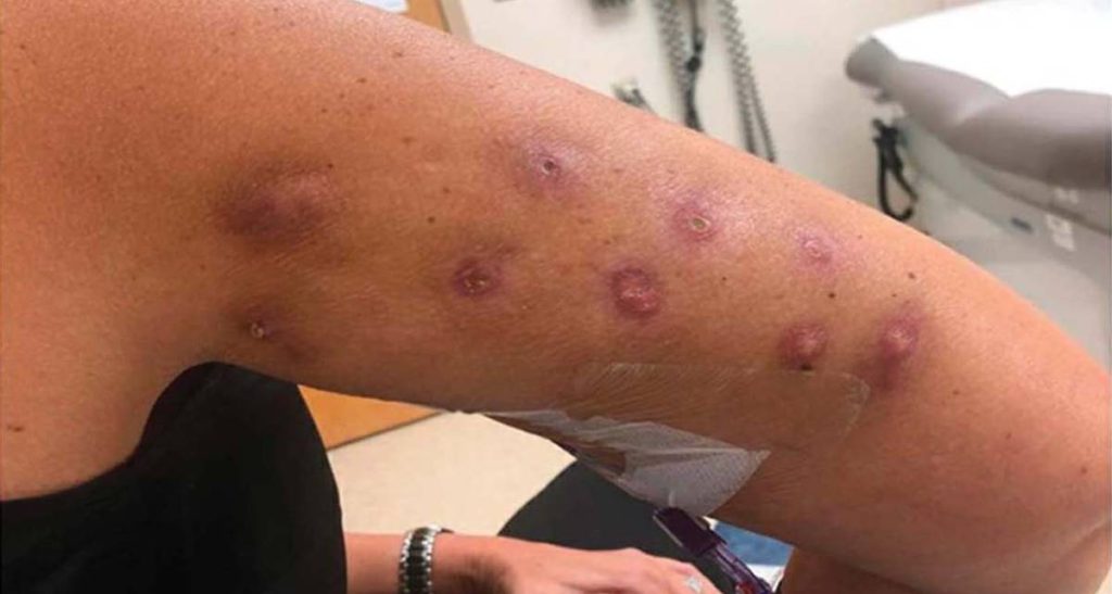 همه چیز درباره عوارض تزریق آنزیم