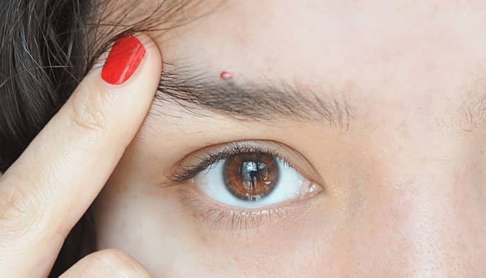 چرا بعد از کاشت ابرو جوش میزند؟