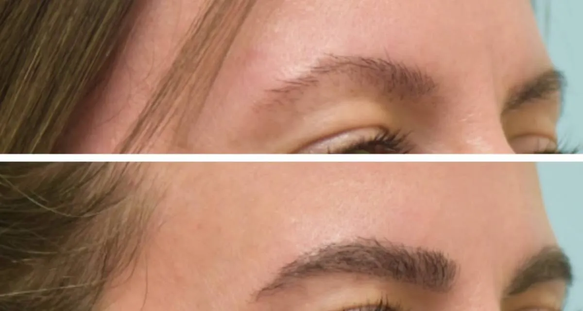 آیا نتایج کاشت ابرو بدون جراحی دائمی است؟