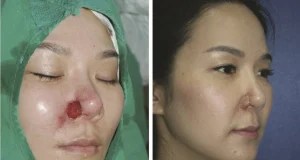 خطرات نکروز بینی