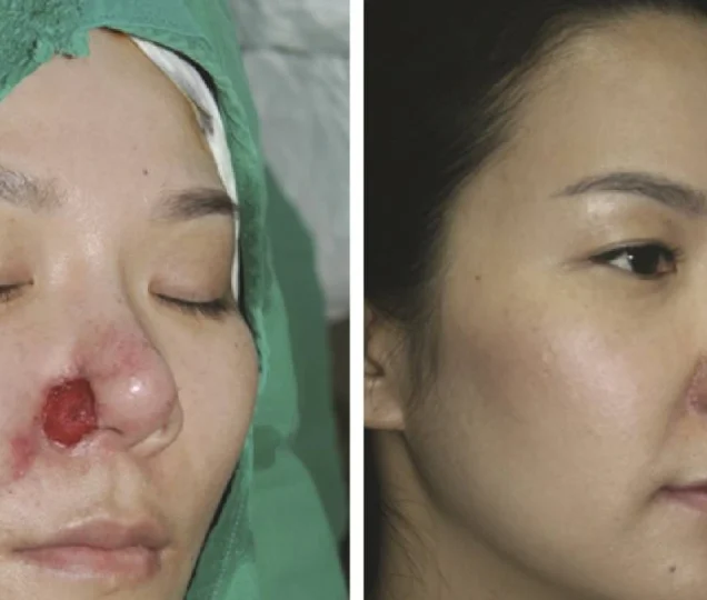 خطرات نکروز بینی