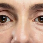 راه های از بین بردن پف زیر چشم