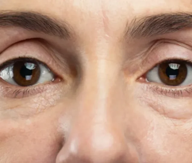 راه های از بین بردن پف زیر چشم