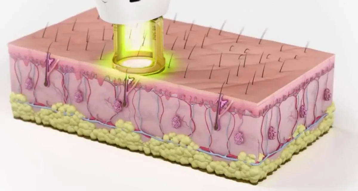 لیزر موهای زائد بیکینی برای چه کسانی مناسب است؟