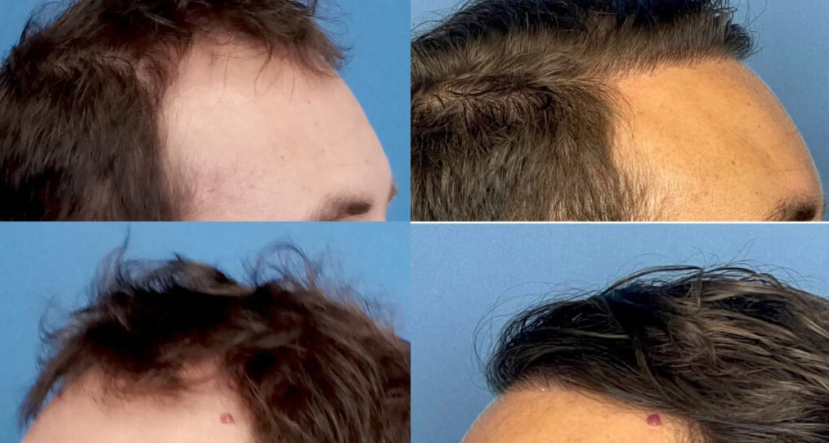 همه چیز درباره کاشت مو