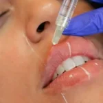 چرا لب‌ها بعد از تزریق فیلر به مراقبت ویژه نیاز دارند؟