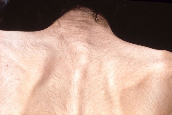 آیا لیزر موهای کرکی ممکن است؟