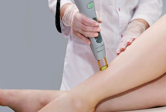 آیا لیزر موهای کرکی ممکن است؟