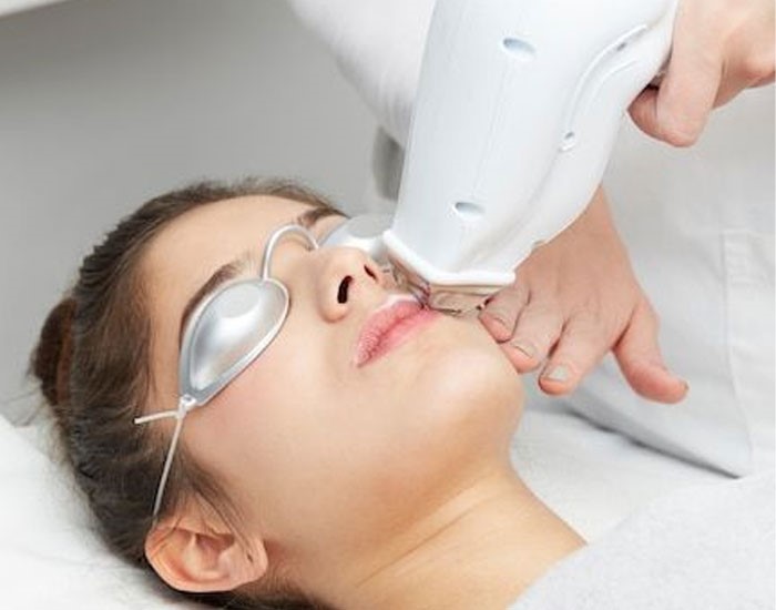 لیزر موهای زائد در افراد با پوست حساس