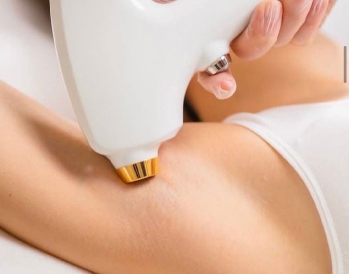 لیزر موهای زائد در افراد با پوست حساس