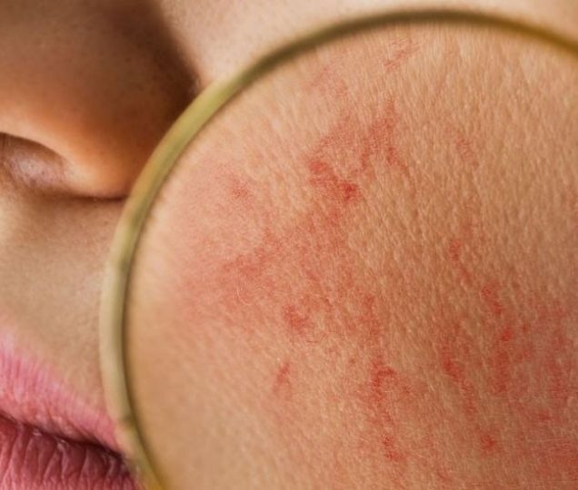 لیزر موهای زائد در افراد با پوست حساس