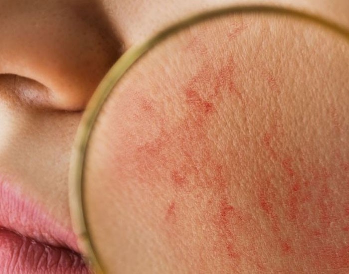 لیزر موهای زائد در افراد با پوست حساس