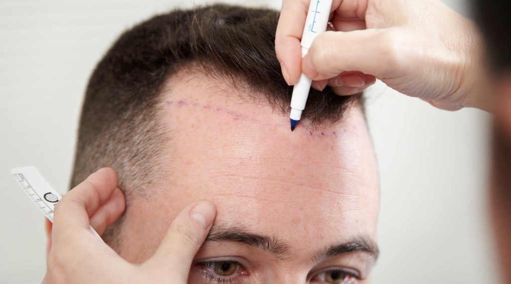 اصطلاحات رایج کاشت مو