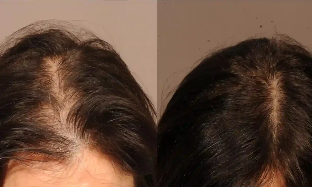 کاشت مو لا به لای موها