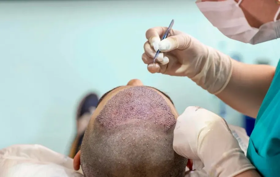 کاشت مو عروسکی