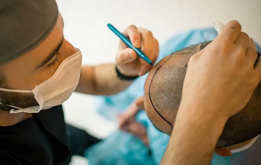 کاشت مو بدون تراش سر