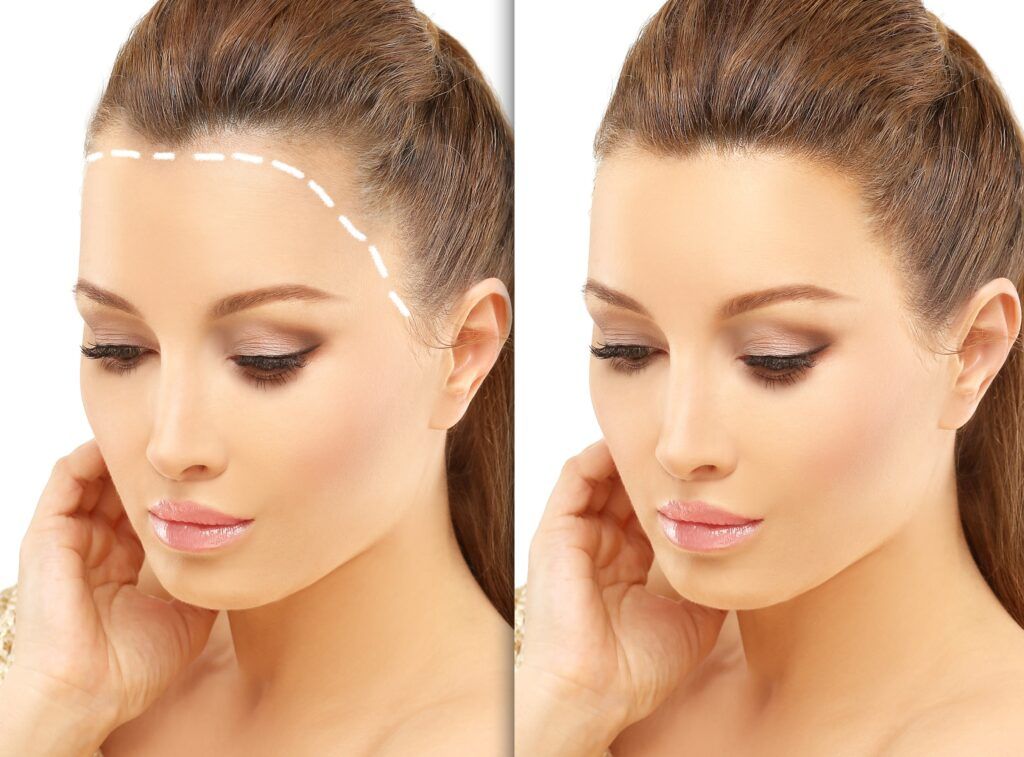 کاشت مو به روش میکروایمپلنت