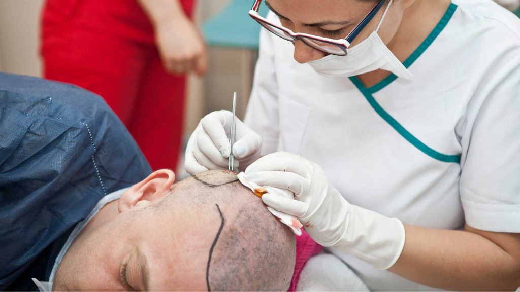 کاشت مو به روش میکروایمپلنت