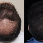 کاشت مو با تراکم بالا