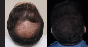 کاشت مو با تراکم بالا