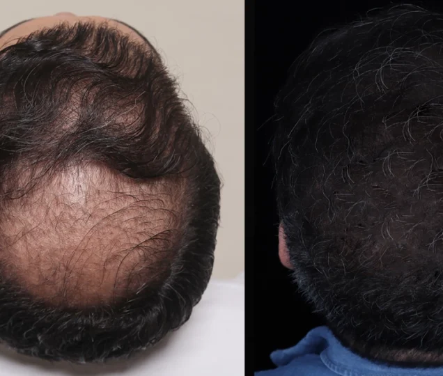 کاشت مو با تراکم بالا